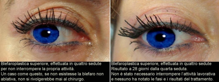 Blefaroplastica