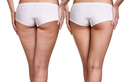 Grasso e cellulite